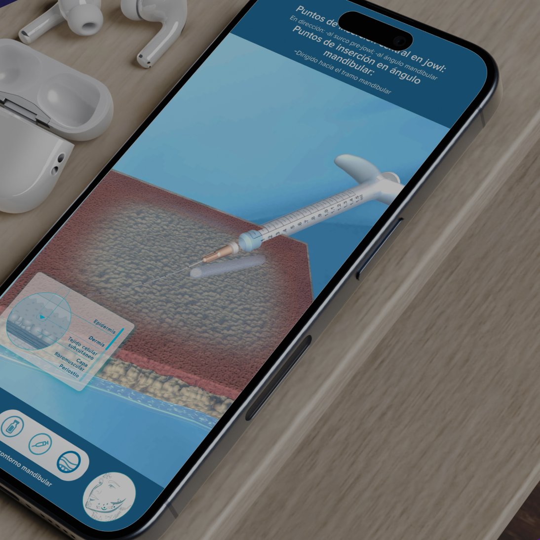 Simulación medica con modelo 3D mostrando puntos de aplicación de Radiesse en un smartphone.